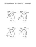 METHOD OF ANCHORING PULLWIRE DIRECTLY ARTICULATABLE REGION IN CATHETER diagram and image