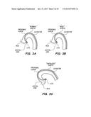 METHOD OF ANCHORING PULLWIRE DIRECTLY ARTICULATABLE REGION IN CATHETER diagram and image