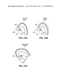 METHOD OF ANCHORING PULLWIRE DIRECTLY ARTICULATABLE REGION IN CATHETER diagram and image