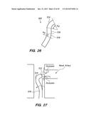 METHOD OF ANCHORING PULLWIRE DIRECTLY ARTICULATABLE REGION IN CATHETER diagram and image