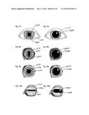 ADAPTABLE EYE ARTIFACT IDENTIFICATION AND CORRECTION SYSTEM diagram and image
