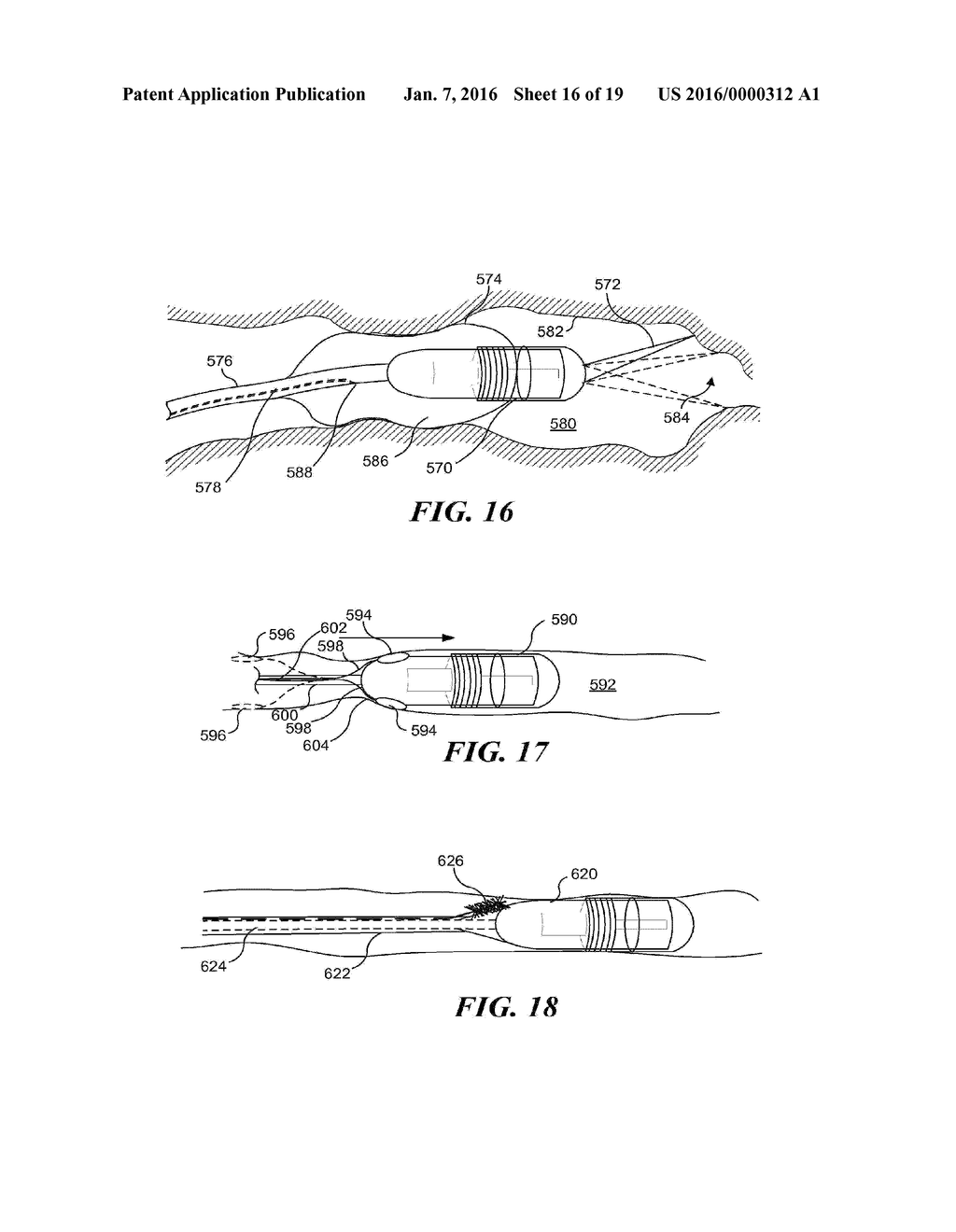 MONITORING DISPOSITION OF TETHERED CAPSULE ENDOSCOPE IN ESOPHAGUS - diagram, schematic, and image 17