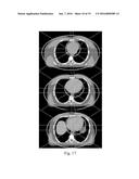 GRATED COLLIMATION SYSTEM FOR COMPUTED TOMOGRAPHY diagram and image