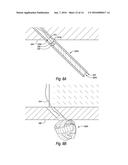 VESSEL CLOSURE DEVICES, SYSTEMS, AND METHODS diagram and image