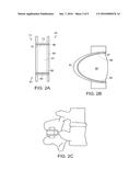 DYNAMIZED INTERSPINAL IMPLANT diagram and image