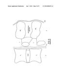 DYNAMIZED INTERSPINAL IMPLANT diagram and image