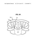 Methods and Devices for Minimally Invasive Spinal Fixation Element     Placement diagram and image