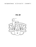 Methods and Devices for Minimally Invasive Spinal Fixation Element     Placement diagram and image