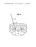 Methods and Devices for Minimally Invasive Spinal Fixation Element     Placement diagram and image