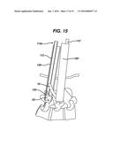 Methods and Devices for Minimally Invasive Spinal Fixation Element     Placement diagram and image