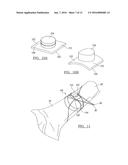 Fracture Fixation Device diagram and image