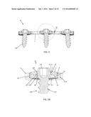 BONE ANCHOR LOCKING DEVICE diagram and image