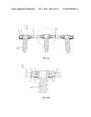 BONE ANCHOR LOCKING DEVICE diagram and image