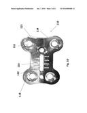 BONE PLATE WITH ATTACHABLE WEDGE diagram and image