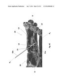 BONE PLATE WITH ATTACHABLE WEDGE diagram and image