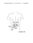 BALLOON CATHETER APPARATUSES FOR RENAL DENERVATION diagram and image