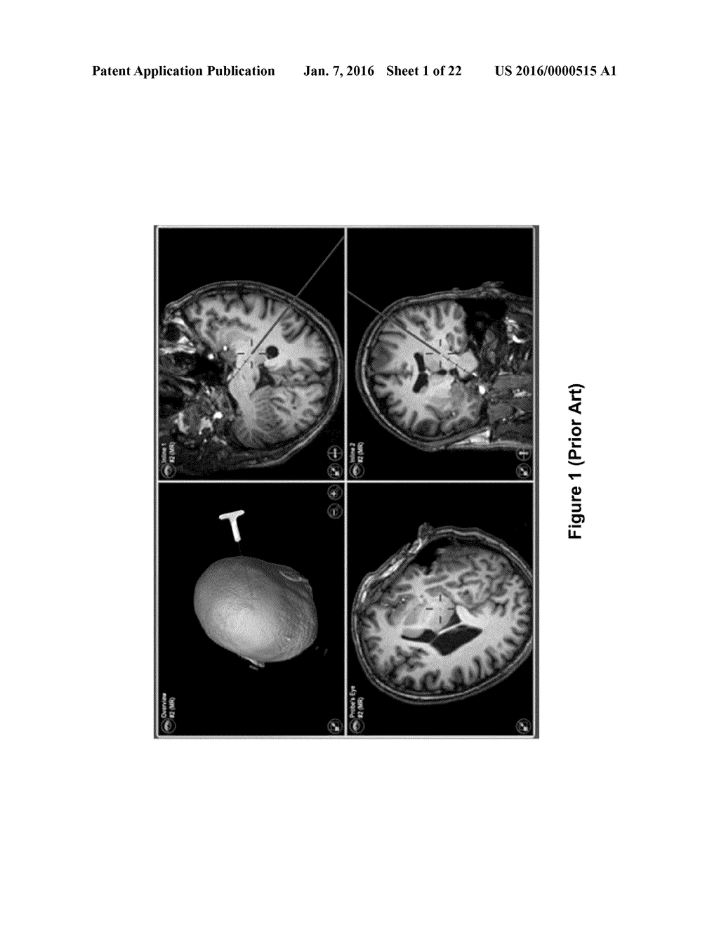 SYSTEM AND METHOD FOR DYNAMIC VALIDATION, CORRECTION OF REGISTRATION FOR     SURGICAL NAVIGATION - diagram, schematic, and image 02