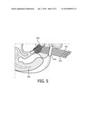 INSTRUMENT LOCALIZATION IN GUIDED HIGH DOSE RATE BRACHYTHERAPY diagram and image