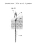 DELIVERY SYSTEMS FOR CARDIAC VALVE SUPPORT DEVICES diagram and image