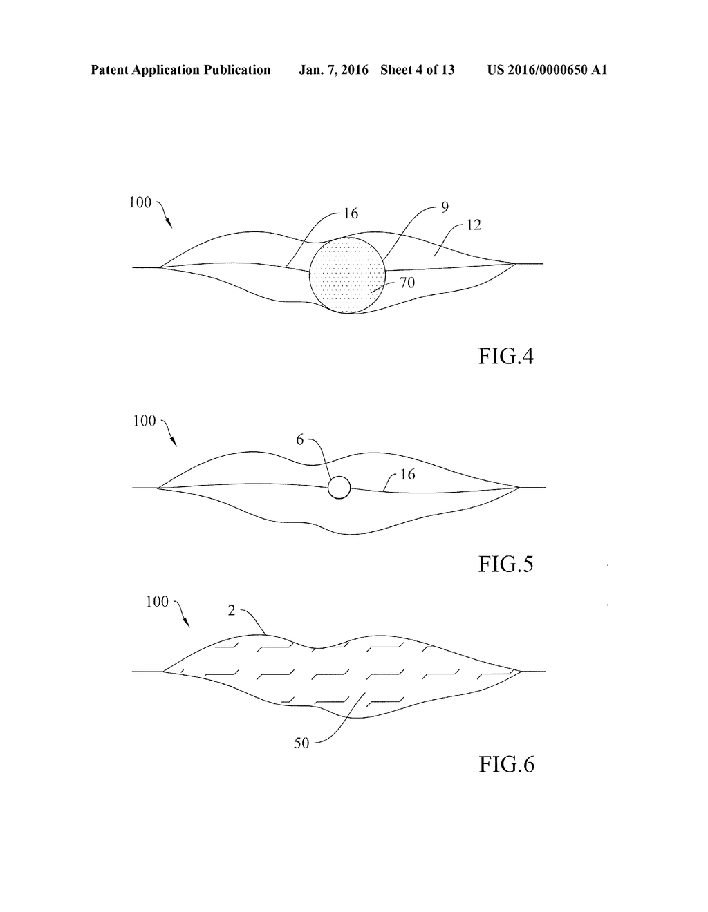 FLEXIBLE PACKAGE WITH A SEALED STERILE CHAMBER FOR THE RECONSITUTION AND     ADMINISTRATION OF FLUID MEDICINAL OR NUTRITIONAL SUBSTANCES INSTILLABLE     INTO THE BODY OF A PATIENT - diagram, schematic, and image 05