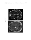 TARGETED TREATMENT OF ANEROBIC CANCER diagram and image