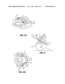 DENTAL APPLIANCE AND METHOD OF PROTECTING DENTITIONS DURING A TRANSORAL     PROCEDURE WITH THE APPLIANCE diagram and image