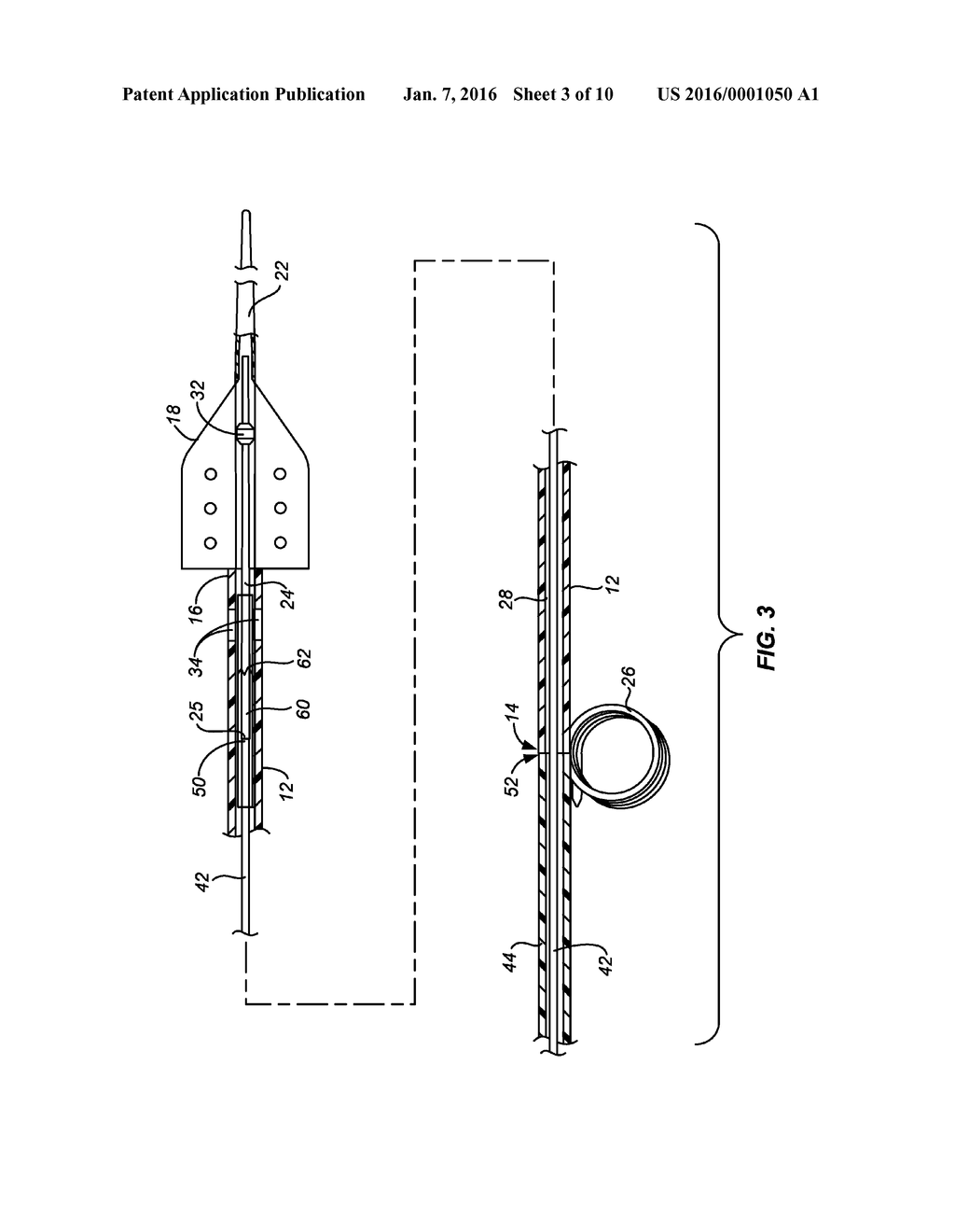 URETERAL STENT AND METHOD AND SYSTEM FOR ITS DEPLOYMENT - diagram, schematic, and image 04