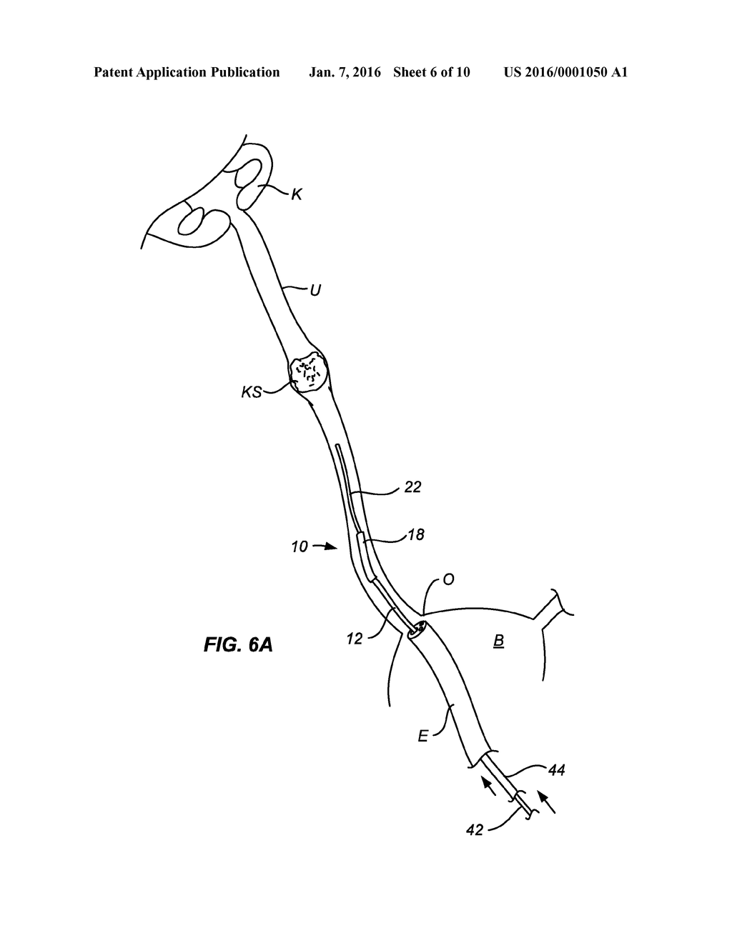 URETERAL STENT AND METHOD AND SYSTEM FOR ITS DEPLOYMENT - diagram, schematic, and image 07