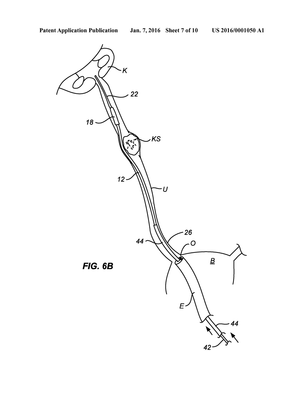 URETERAL STENT AND METHOD AND SYSTEM FOR ITS DEPLOYMENT - diagram, schematic, and image 08