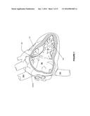 FIXATION FOR IMPLANTABLE MEDICAL DEVICES diagram and image