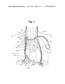 SYSTEM AND METHOD TO MODULATE PHRENIC NERVE TO PREVENT SLEEP APNEA diagram and image