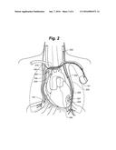 SYSTEM AND METHOD TO MODULATE PHRENIC NERVE TO PREVENT SLEEP APNEA diagram and image