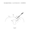 DEVICE AND METHOD FOR ASISSTING LAPAROSCOPIC SURGERY - RULE BASED APPROACH diagram and image