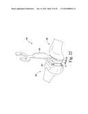 METHOD OF ASSEMBLING AND POSITIONING A FEMORAL ORTHOPAEDIC SURGICAL     INSTRUMENT diagram and image