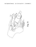 METHOD OF ASSEMBLING AND POSITIONING A FEMORAL ORTHOPAEDIC SURGICAL     INSTRUMENT diagram and image