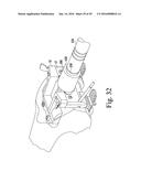 METHOD OF ASSEMBLING AND POSITIONING A FEMORAL ORTHOPAEDIC SURGICAL     INSTRUMENT diagram and image