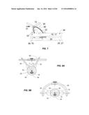 Blood Vessel Treatment with Pressure Shock Waves diagram and image