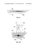 Blood Vessel Treatment with Pressure Shock Waves diagram and image