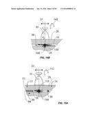 Blood Vessel Treatment with Pressure Shock Waves diagram and image