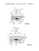 Blood Vessel Treatment with Pressure Shock Waves diagram and image