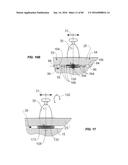 Blood Vessel Treatment with Pressure Shock Waves diagram and image