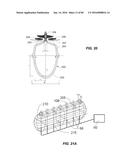 Blood Vessel Treatment with Pressure Shock Waves diagram and image