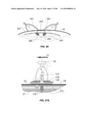 Blood Vessel Treatment with Pressure Shock Waves diagram and image