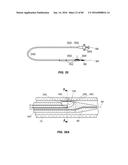 Blood Vessel Treatment with Pressure Shock Waves diagram and image