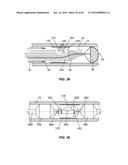 Blood Vessel Treatment with Pressure Shock Waves diagram and image