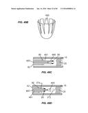 Blood Vessel Treatment with Pressure Shock Waves diagram and image