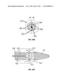 Blood Vessel Treatment with Pressure Shock Waves diagram and image