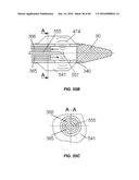 Blood Vessel Treatment with Pressure Shock Waves diagram and image