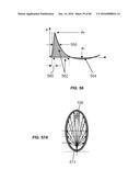 Blood Vessel Treatment with Pressure Shock Waves diagram and image