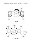 Blood Vessel Treatment with Pressure Shock Waves diagram and image